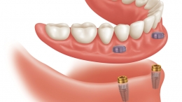 El futuro de las dentaduras postizas