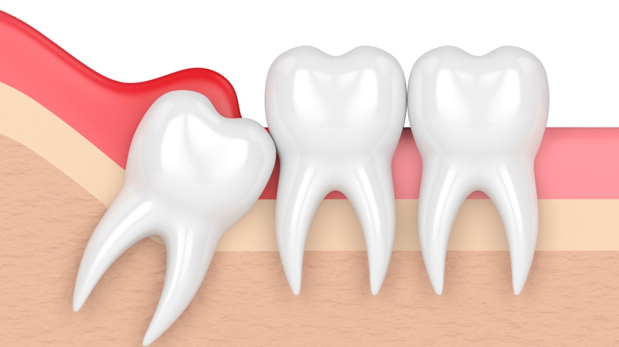 ¿Qué es la periocoronitis?