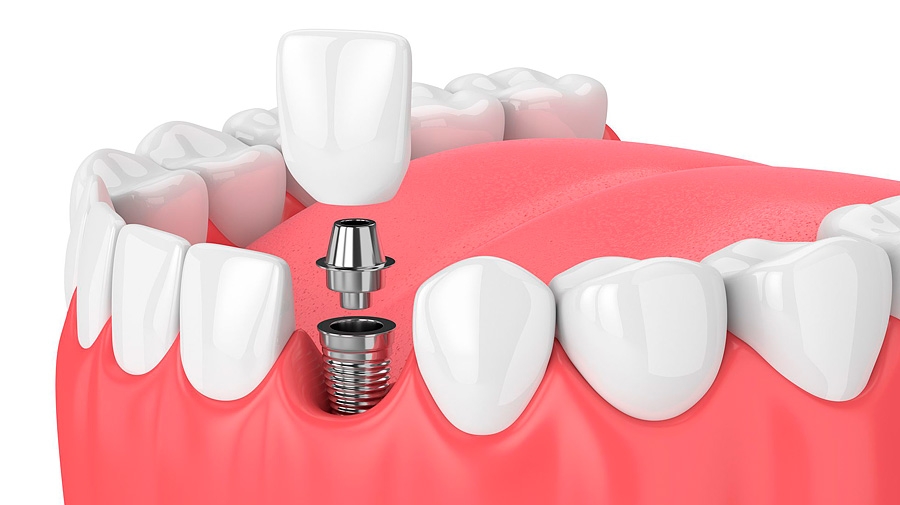 Tipos de implantes dentales (I)